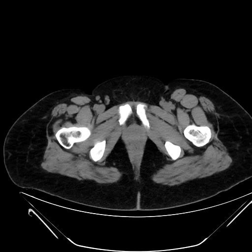 File:Bilateral ovarian mature cystic teratomas (Radiopaedia 79373-92457 Axial non-contrast 96).jpg