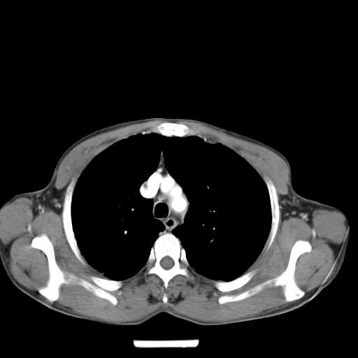 Bilateral parotid gland lymphoma (Radiopaedia 21038-20969 A 27).jpg