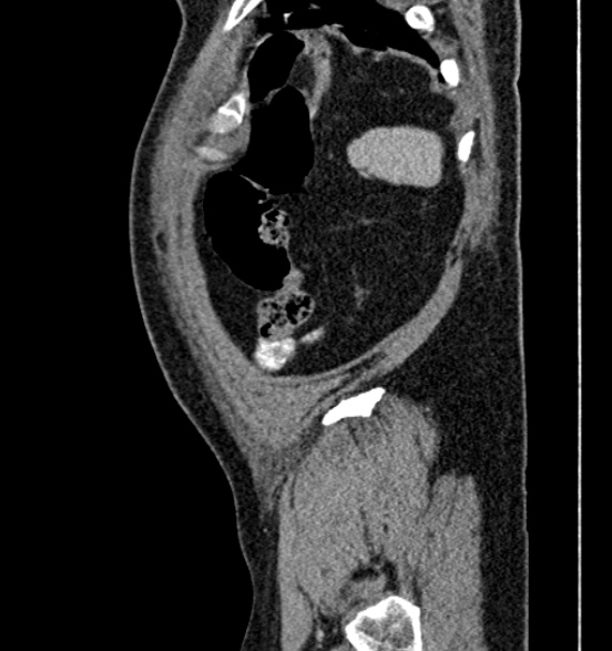 File:Bilateral rectus sheath hematomas (Radiopaedia 50778-56252 B 70).jpg
