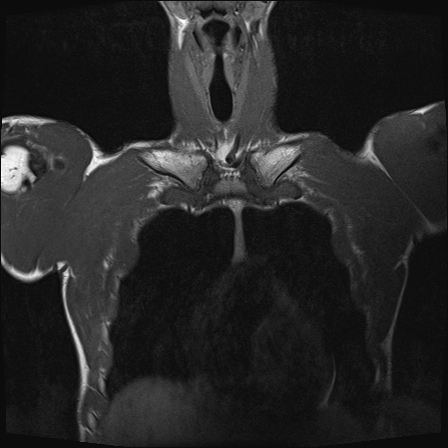 File:Bilateral spinoglenoid notch ganglion cysts (Radiopaedia 29577-30082 Coronal T1 4).jpg