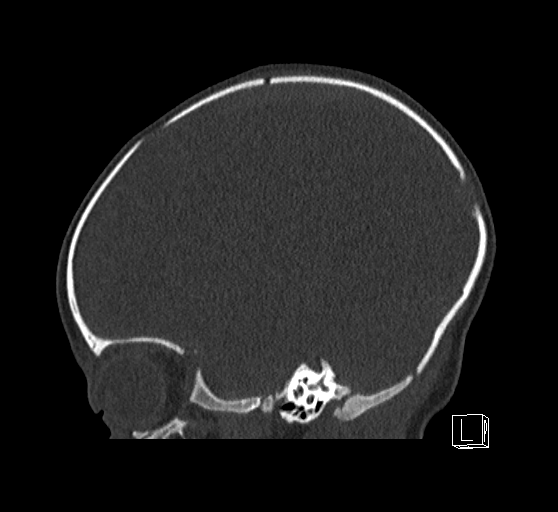 Bilateral subdural hemorrhage and parietal skull fracture (Radiopaedia 26058-26192 Sagittal bone window 68).png