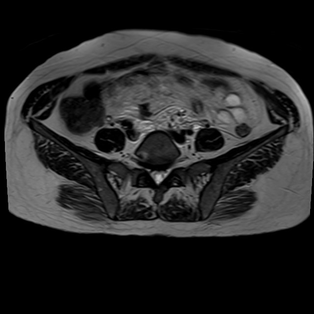 Bilateral tubo-ovarian abscesses (Radiopaedia 58635-65829 Axial T2 3).jpg