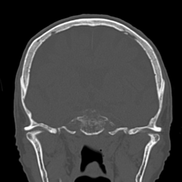 Biparietal osteodystrophy (Radiopaedia 46109-50463 Coronal bone window 52).jpg
