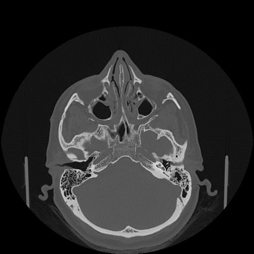 File:Bisphosphonate-related osteonecrosis of the jaw (Radiopaedia 71324-81642 Axial bone window 162).jpg