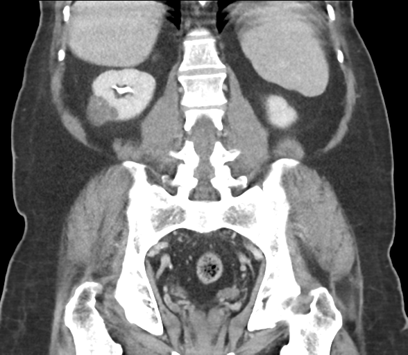 Bladder papillary urothelial carcinoma (Radiopaedia 48119-52951 C 47).png