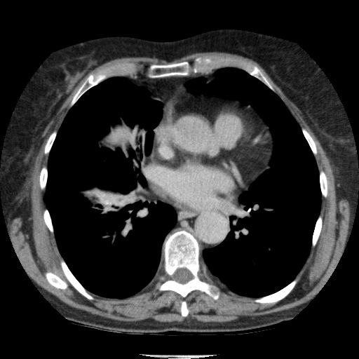 Bladder tumor detected on trauma CT (Radiopaedia 51809-57609 C 4).jpg