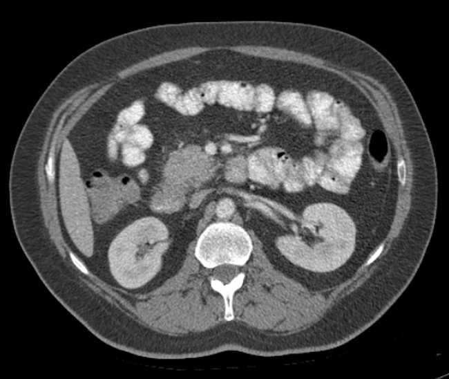 Bleeding duodenal ulcer and adenomyomatosis of gallbladder (Radiopaedia 61834-69861 A 50).jpg