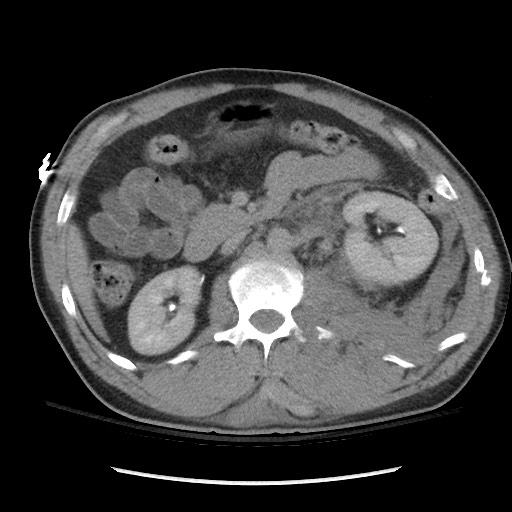 Blunt abdominal trauma with solid organ and musculoskelatal injury with active extravasation (Radiopaedia 68364-77895 Axial C+ delayed 57).jpg