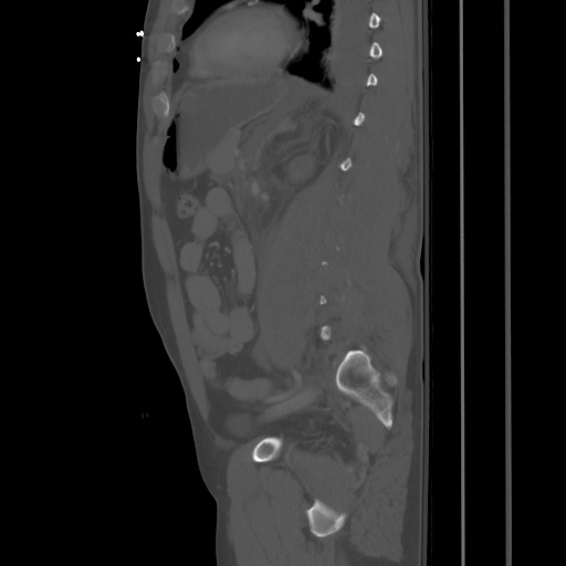 Blunt abdominal trauma with solid organ and musculoskelatal injury with active extravasation (Radiopaedia 68364-77895 Sagittal bone window 67).jpg