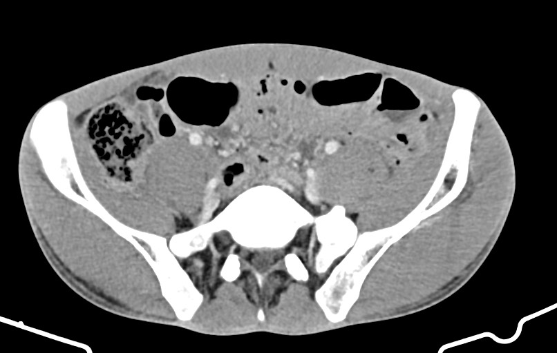 Blunt injury to the small bowel (Radiopaedia 74953-85987 A 140).jpg