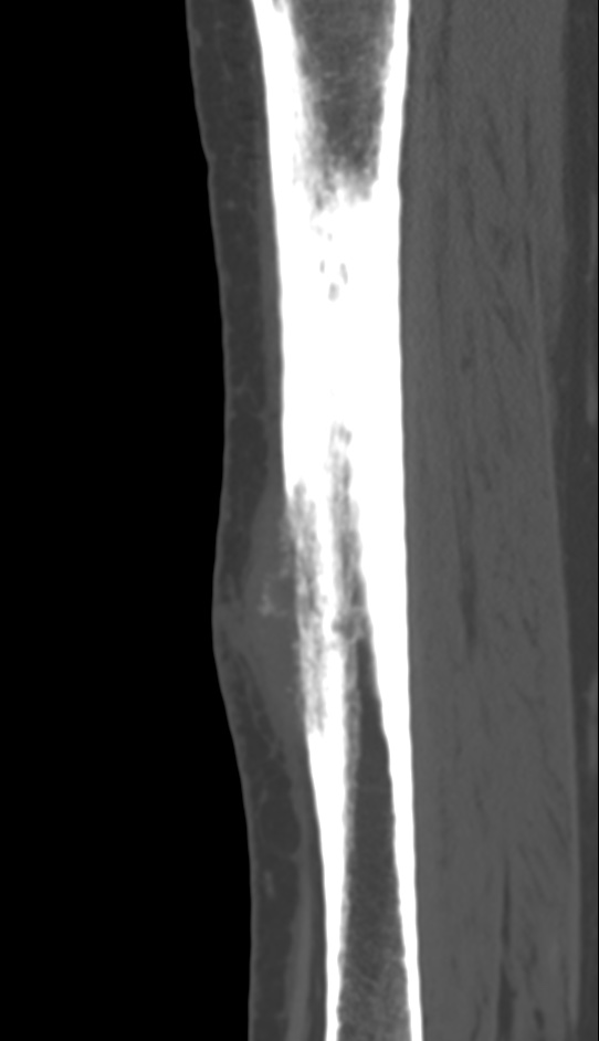 Bone metastasis - tibia (Radiopaedia 57665-64609 Sagittal bone window 95).jpg