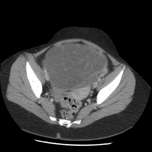 File:Borderline mucinous tumor (ovary) (Radiopaedia 78228-90808 A 124).jpg
