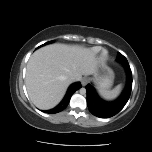 File:Borderline mucinous tumor (ovary) (Radiopaedia 78228-90808 A 66).jpg