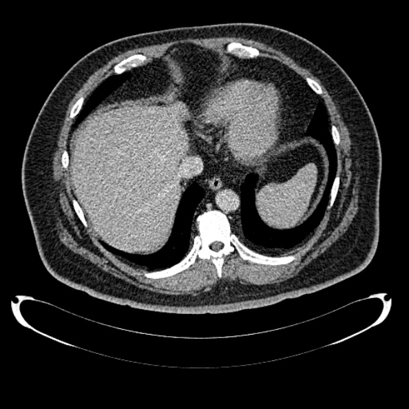 Bosniak renal cyst - type IV (Radiopaedia 24244-24518 C 22).jpg