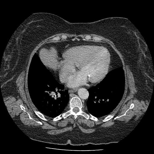 Bovine aortic arch - right internal mammary vein drains into the superior vena cava (Radiopaedia 63296-71875 A 104).jpg
