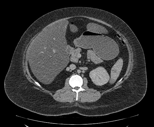 Bowel and splenic infarcts in acute lymphocytic leukemia (Radiopaedia 61055-68913 A 55).jpg