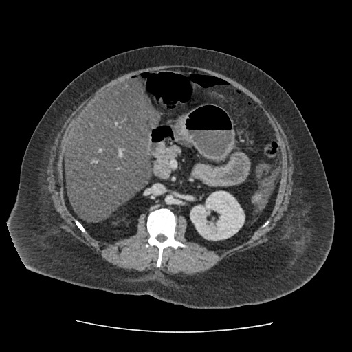Bowel and splenic infarcts in acute lymphocytic leukemia (Radiopaedia 61055-68915 A 58).jpg