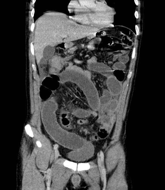 Bowel obstruction from colon carcinoma (Radiopaedia 22995-23028 C 24).jpg