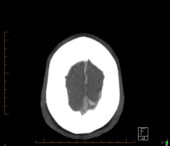 Brachiocephalic trunk stenosis (Radiopaedia 87242-103519 A 4).jpg