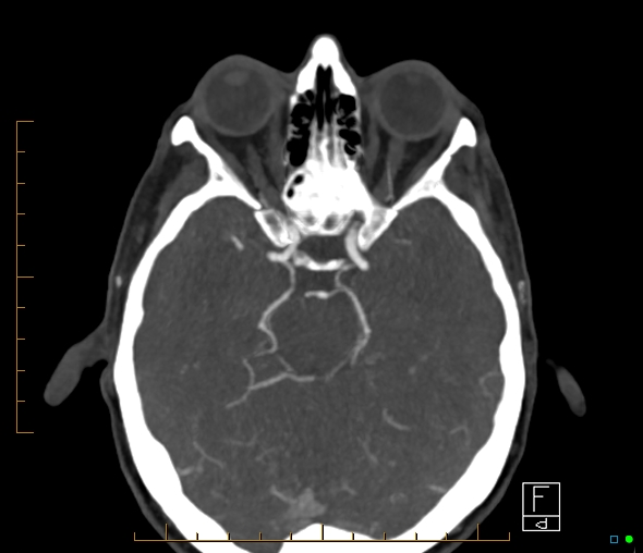 Brachiocephalic trunk stenosis (Radiopaedia 87242-103519 A 44).jpg