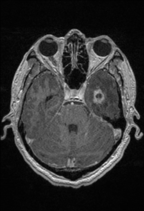 Brain abscess with ventriculitis (Radiopaedia 85703-101495 Axial T1 C+ 59).jpg