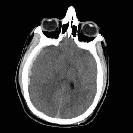 File:Brain death after motor vehicle collision (Radiopaedia 88470-105114 Axial 4).png