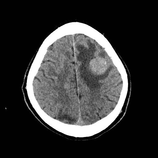 File:Brain metastases from lung cancer (Radiopaedia 83839-99027 Axial non-contrast 28).jpg