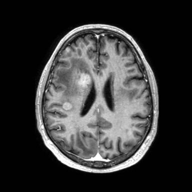 File:Brain metastases from lung cancer (Radiopaedia 83839-99028 Axial T1 C+ 42).jpg