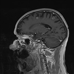 Brain metastasis (Radiopaedia 42617-45761 Sagittal T1 C+ 62).jpg
