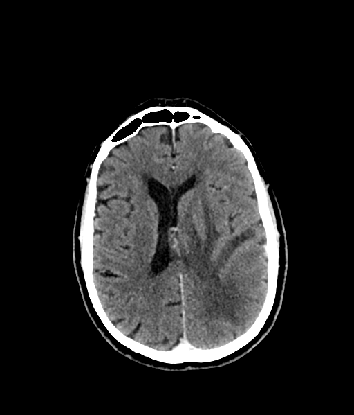 Brain metastasis (large cystic mass) (Radiopaedia 47497-52106 Axial C+ 38).png