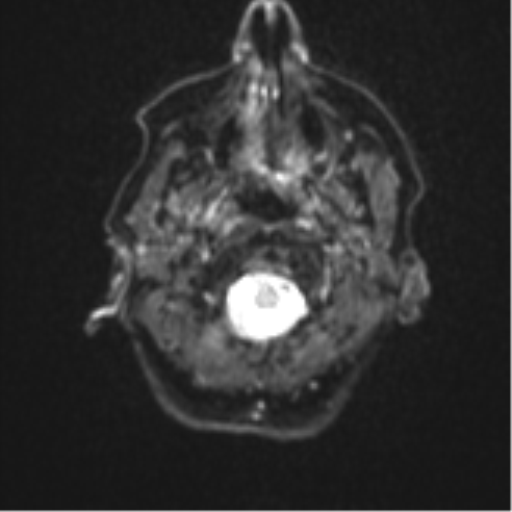 File:Brain metastasis (sarcoma) (Radiopaedia 47576-52209 Axial DWI 2).png