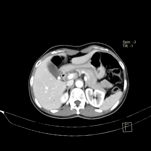 Brain metastasis as initial presentation of non-small cell lung cancer (Radiopaedia 65122-74127 A 51).jpg