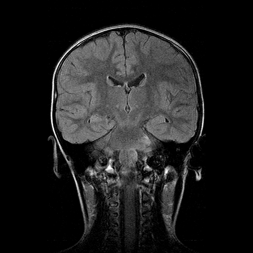 File:Brainstem ganglioglioma (Radiopaedia 10763-11224 Coronal FLAIR 9).jpg