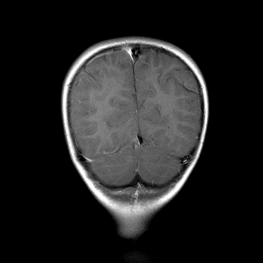 File:Brainstem ganglioglioma (Radiopaedia 10763-11224 Coronal T1 C+ 4).jpg