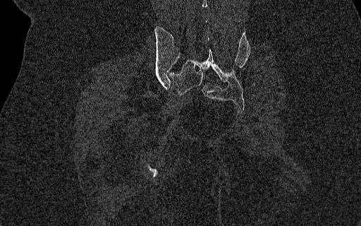 File:Breast carcinoma with pathological hip fracture (Radiopaedia 60314-67993 Coronal bone window 89).jpg