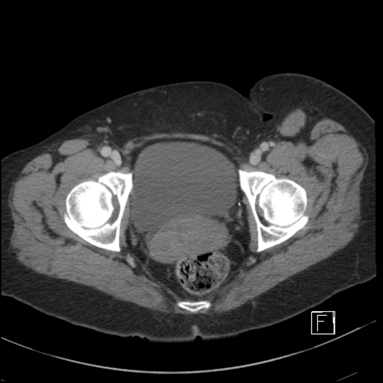 File:Breast metastases from renal cell cancer (Radiopaedia 79220-92225 C 113).jpg