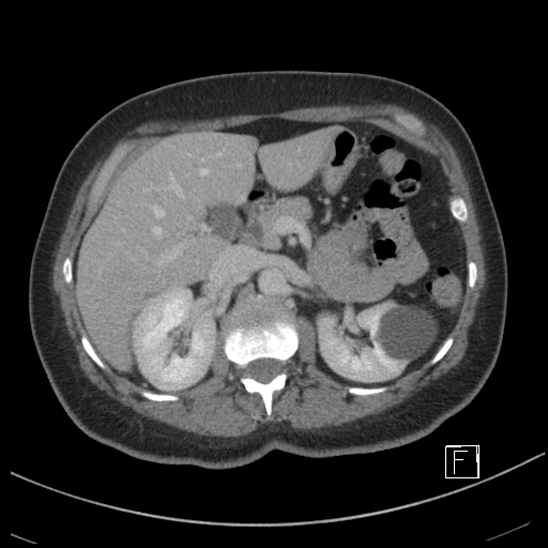 File:Breast metastases from renal cell cancer (Radiopaedia 79220-92225 C 31).jpg