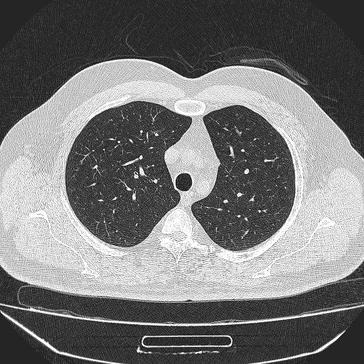 File:Bronchial atresia (Radiopaedia 58271-65417 Axial lung window 11).jpg