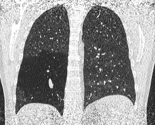 Bronchial atresia (Radiopaedia 58271-65417 Coronal lung window 42).jpg