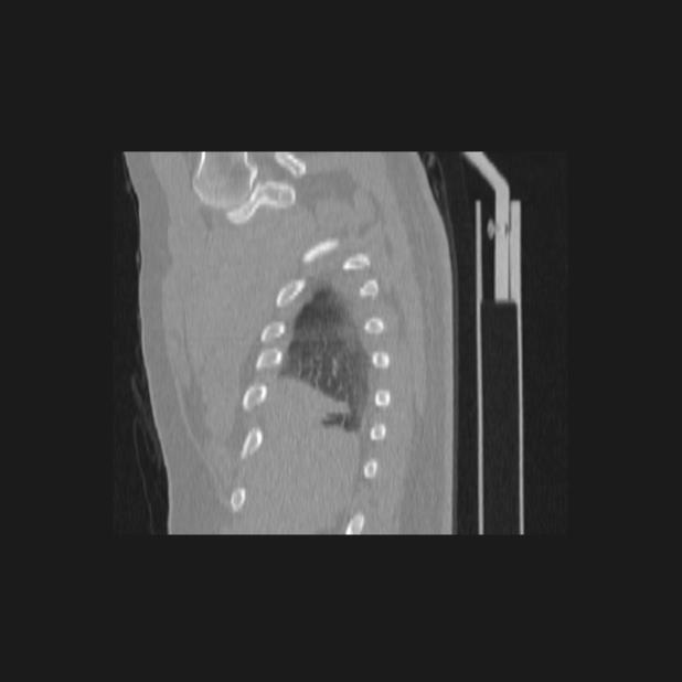 Bronchial atresia (Radiopaedia 60685-68439 Sagittal lung window 5).jpg