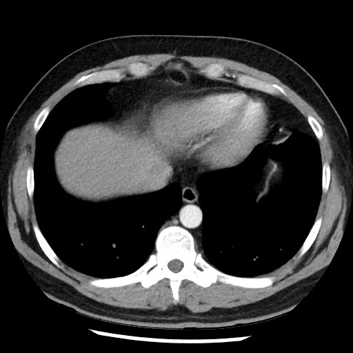 File:Bronchial carcinoid tumor (Radiopaedia 67377-76764 A 48).jpg