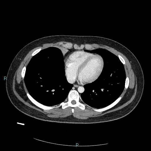 File:Bronchial carcinoid tumor (Radiopaedia 78272-90875 A 66).jpg