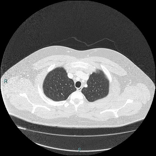 Bronchial carcinoid tumor (Radiopaedia 78272-90875 Axial lung window 7).jpg
