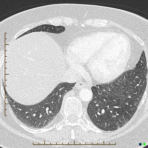 File:Bronchial diverticula (Radiopaedia 79512-92676 Axial lung window 159).jpg