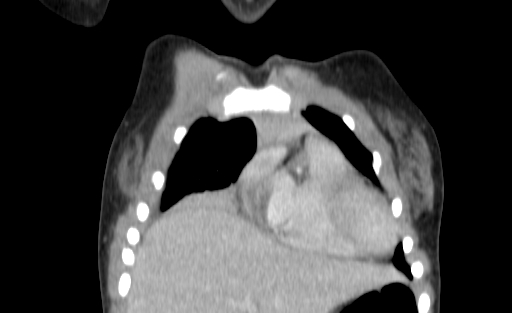 Bronchial mucoepidermoid carcinoma (Radiopaedia 57023-63895 Coronal 16).jpg