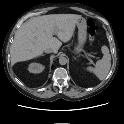 File:Bronchial stenosis - lung transplant (Radiopaedia 73133-83848 Axial non-contrast 57).jpg
