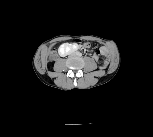 File:Bronchiectasis in Crohn disease (Radiopaedia 60311-67977 B 98).jpg