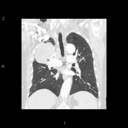 File:Bronchogenic carcinoma as an incidental finding (Radiopaedia 16453-16130 Coronal lung window 30).jpg