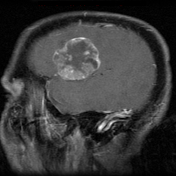 File:Bronchogenic carcinoma brain metastasis (Radiopaedia 9286-9969 Sagittal T1 C+ 1).jpg