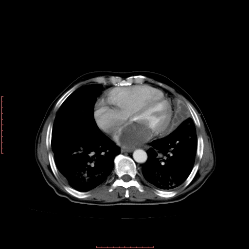 File:Bronchogenic carcinoma with left atrial large deposit - T4N3M1a (Radiopaedia 42316-45428 A 20).jpg